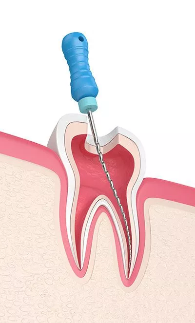diagram of a root canal